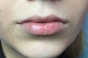 Увеличение объема губ